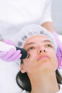 Smoother-looking fine lines after microneedling in Calgary