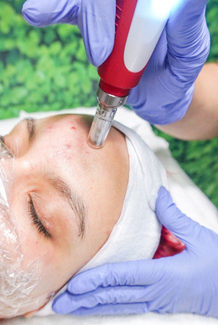 Hygiene and safety standards for microneedling treatment